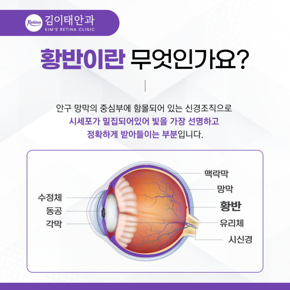 황반변성 건성과 습성 구분 설명 이미지