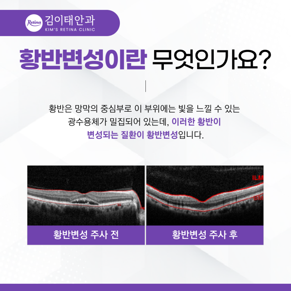 천안망막안과 황반변성 정밀검사 안내