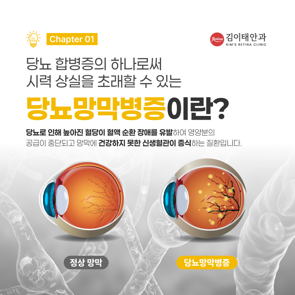 천안 당뇨망막병증 진행 단계 안내 2