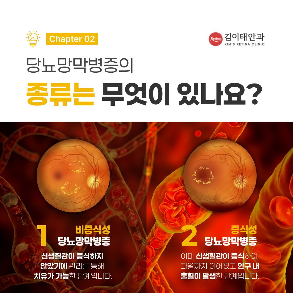 천안망막검사 정밀 검사 장비 안내 3