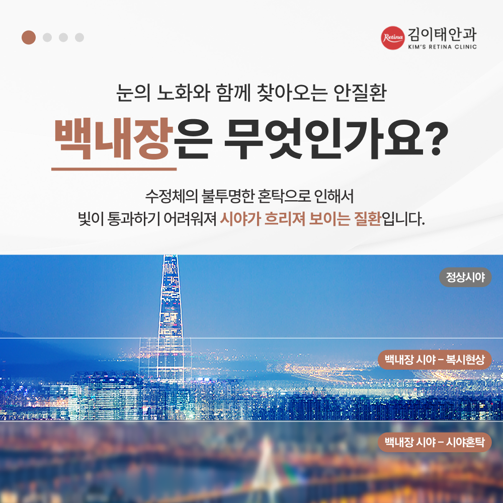 천안 백내장 증상 및 진행 안내 2