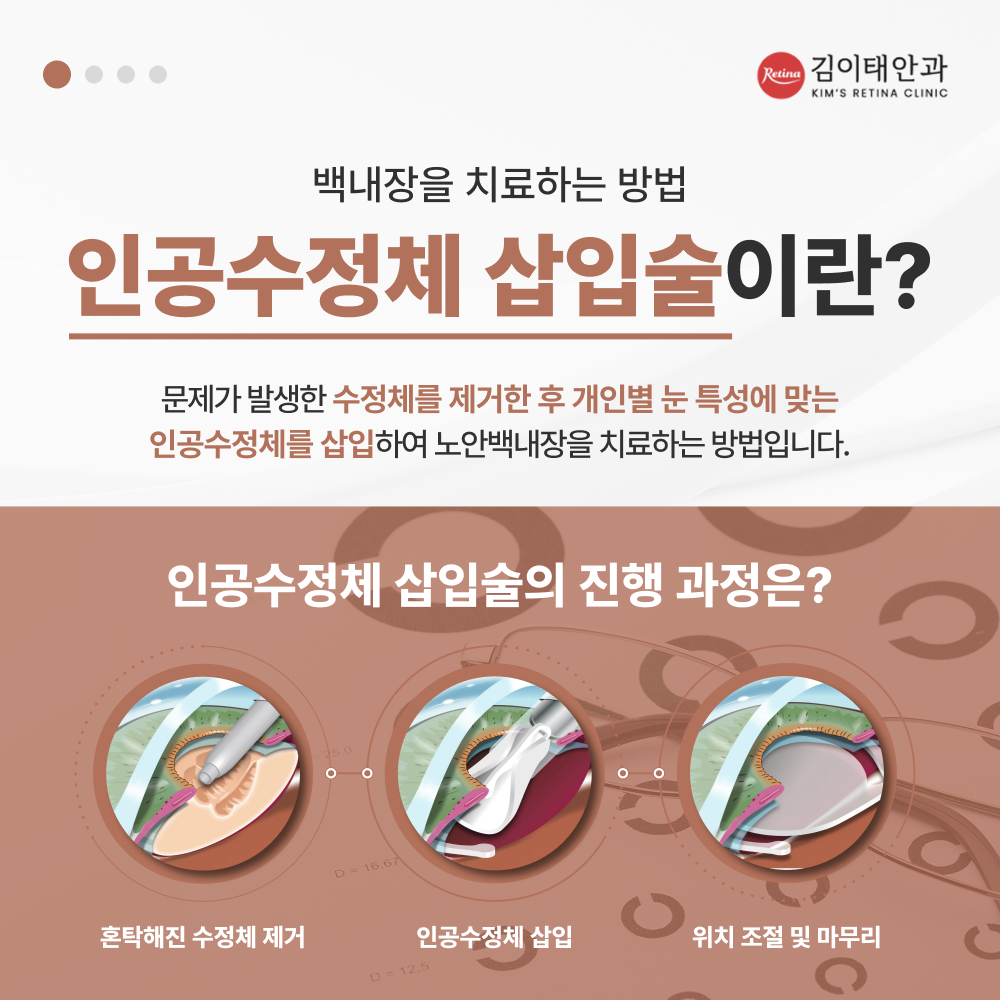 천안 다초점 인공수정체 안내 4